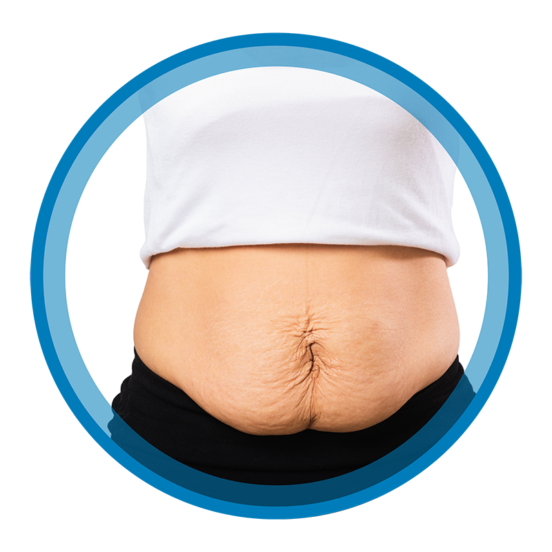 Abdominoplastía Bono PAD